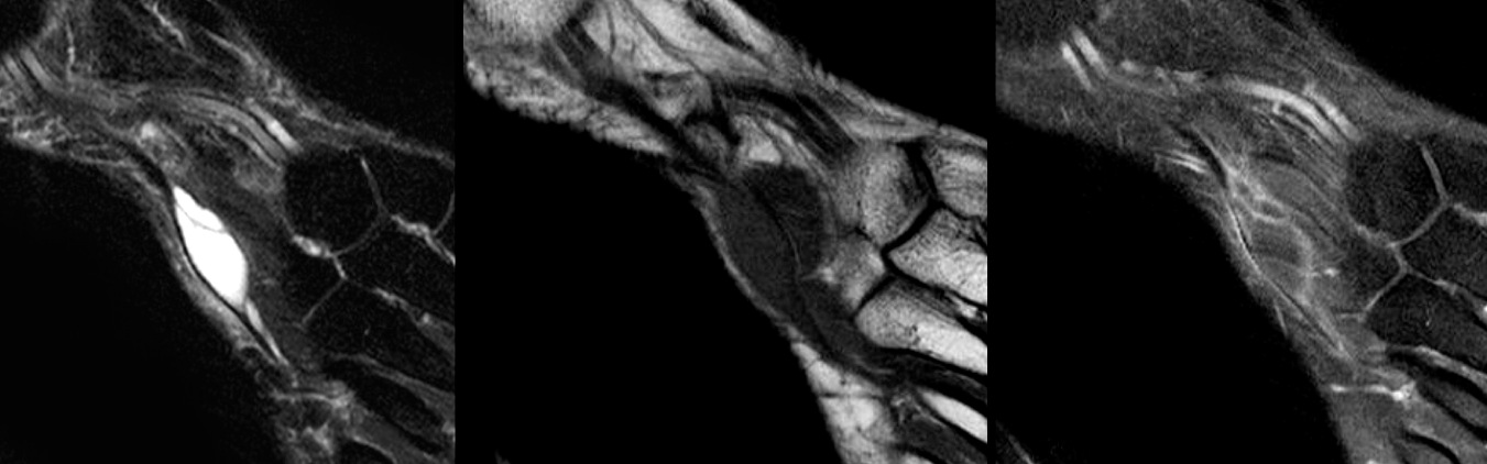 Figure 3 for case Intratendinous ganglion